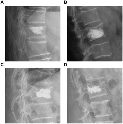 Establishing a nomogram to predict refracture after percutaneous kyphoplasty by logistic regression